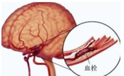 脑动脉硬化症状,症状解析与早期识别